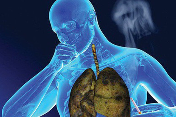  Học ngay cách nhận biết 6 dấu hiệu u phổi dễ dàng - Bạn chớ nên bỏ qua!